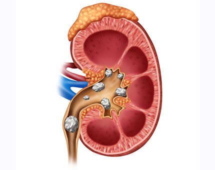 Homeopathy for Urological Conditions